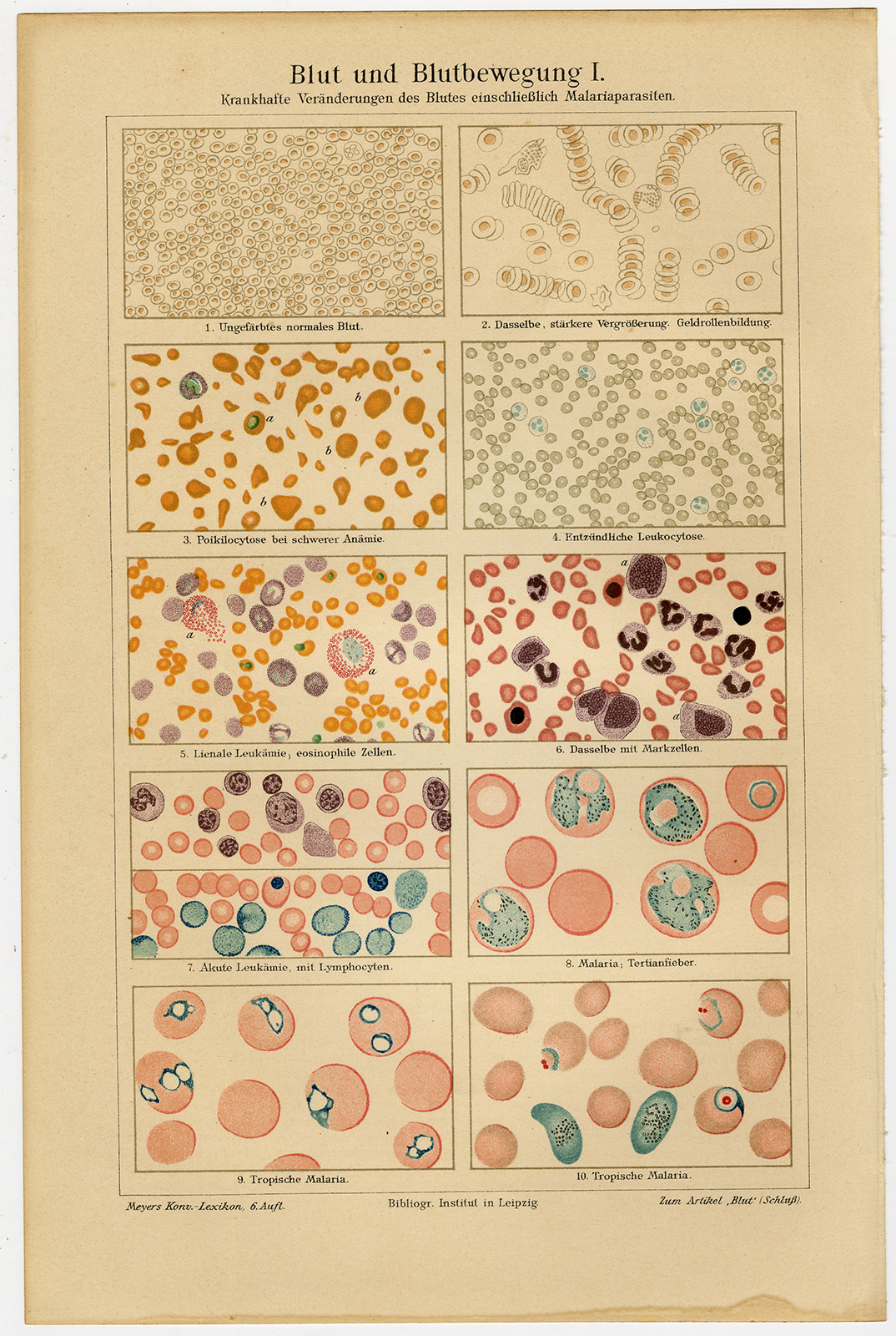 , Antique Prints-BLOOD MOVEMENT-LEUKEMIA-MALARIA-Meyers-1902, Pictura Antique Prints