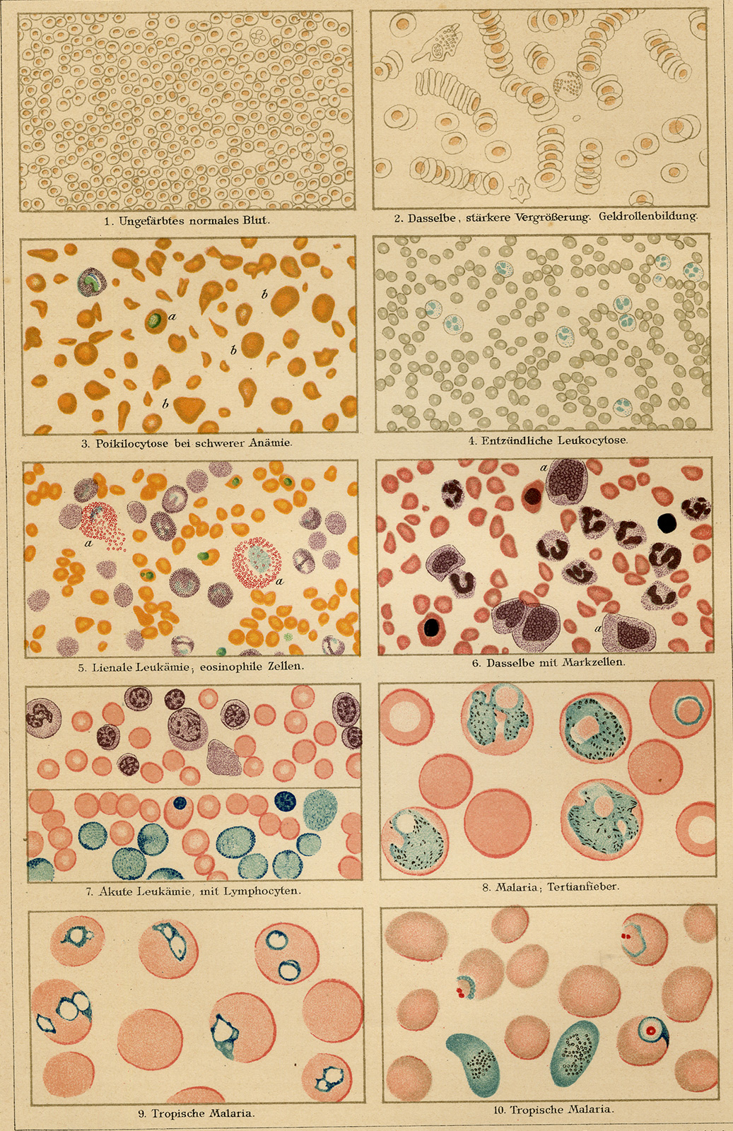 , Antique Prints-BLOOD MOVEMENT-LEUKEMIA-MALARIA-Meyers-1902, Pictura Antique Prints