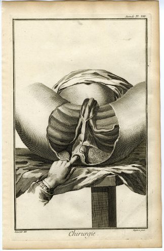 Antique Print-SURGERY-MEDICAL INSTRUMENT-MUSCLES-PERINEUM-Diderot-Defehrt-1751