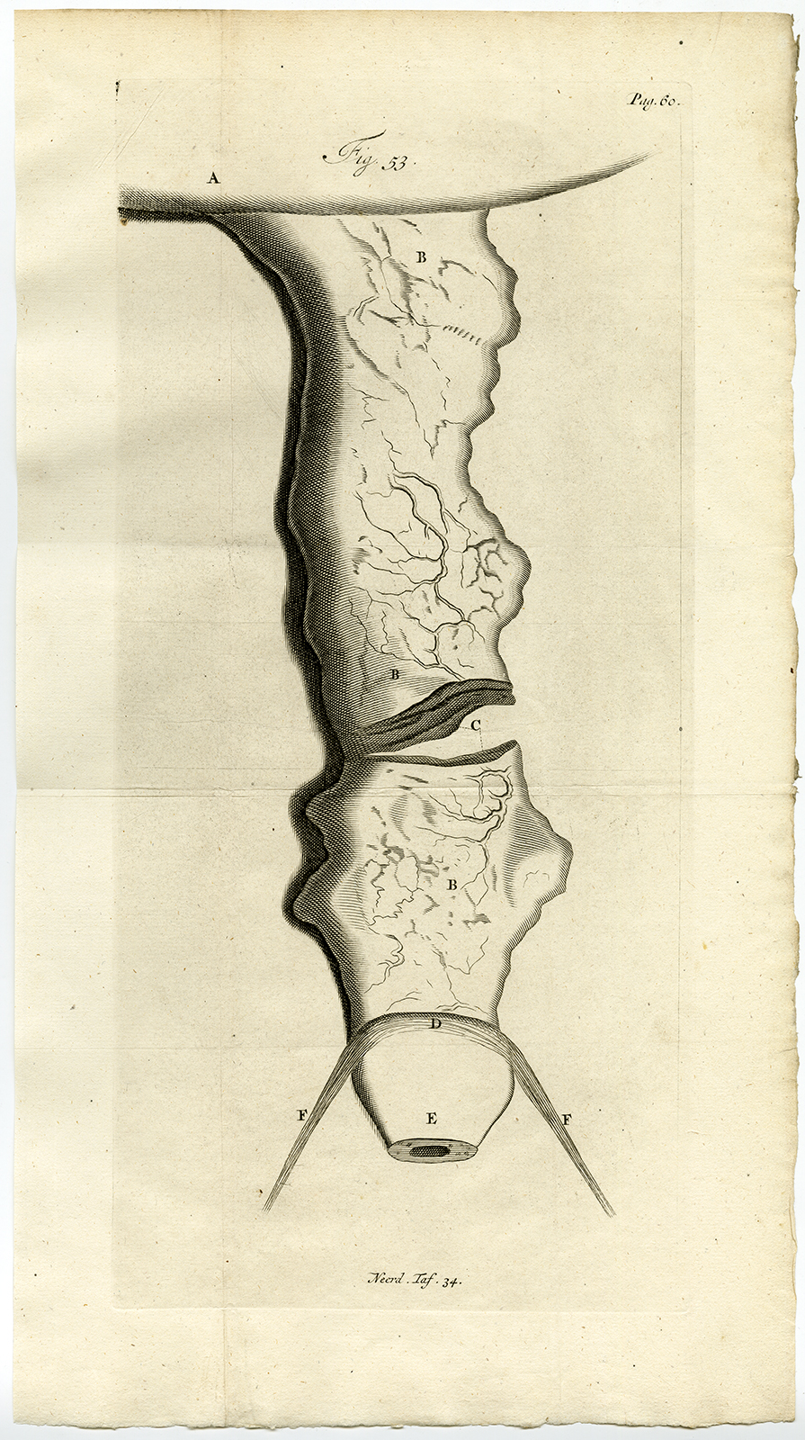 , Antique Print-TUMOUR-STOMACH-BIRTH-WOMB-FIG 53-Ruysch-Huyberts-1744, Pictura Antique Prints