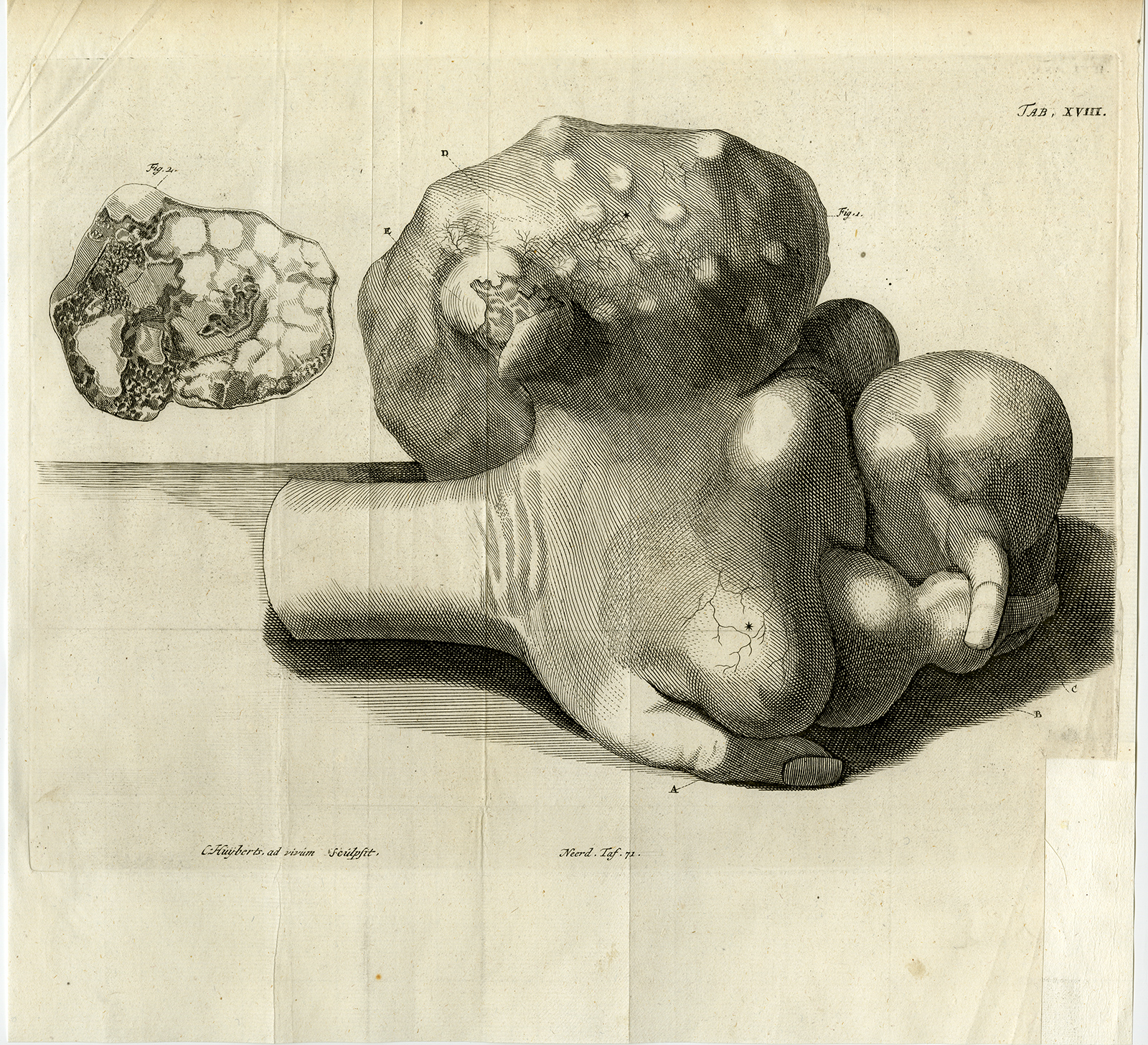 , Antique Print-HAND-DEFORMED-SECTION-TUMOUR-TAB XVII-Ruysch-Huyberts-1744, Pictura Antique Prints
