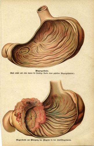 Antique Medical Print-STOMACH-INFECTIONS-1890