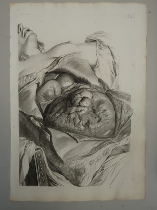 Antique Print-T.55.-ANATOMY-UTERUS-POSTPARTUM-de Lairesse-Bidloo-1728