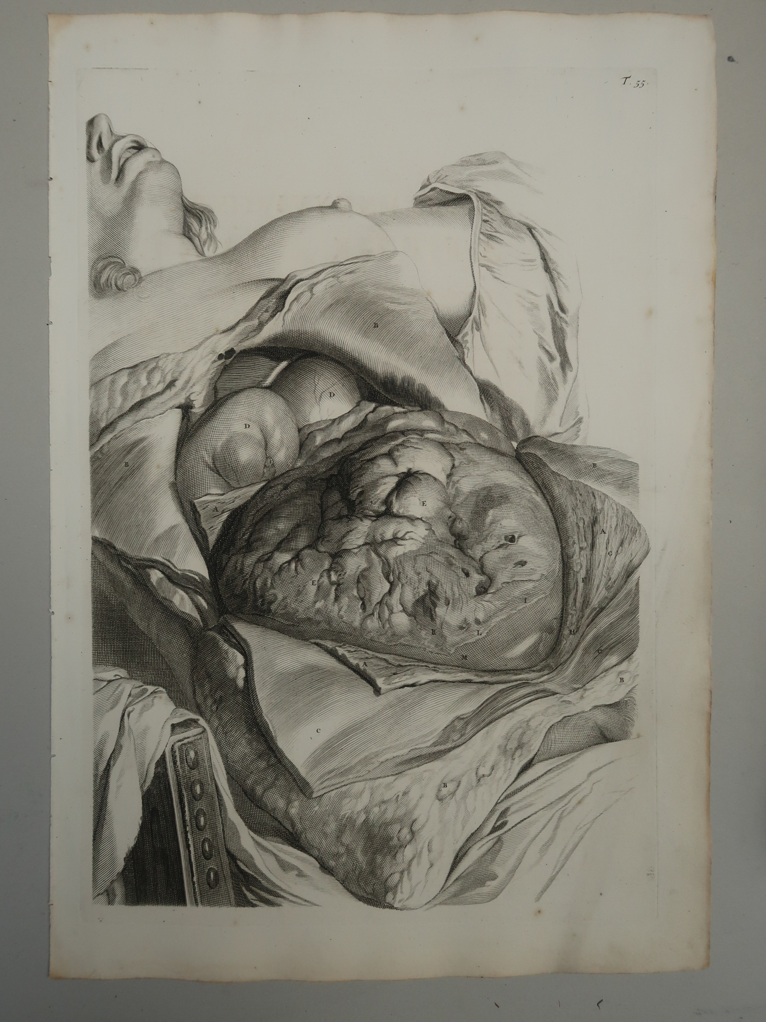 , Antique Print-T.55.-ANATOMY-UTERUS-POSTPARTUM-de Lairesse-Bidloo-1728, Pictura Antique Prints