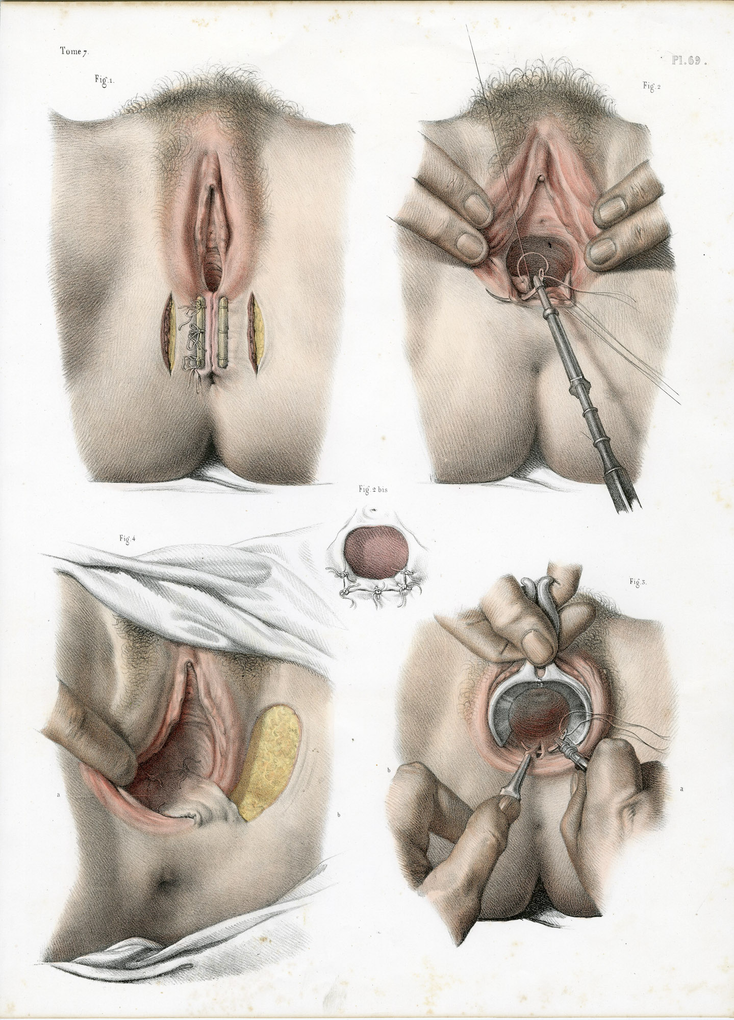 Pictura 14085 416x578 Catalogue-Bourgery-Human anatomy - Image 40