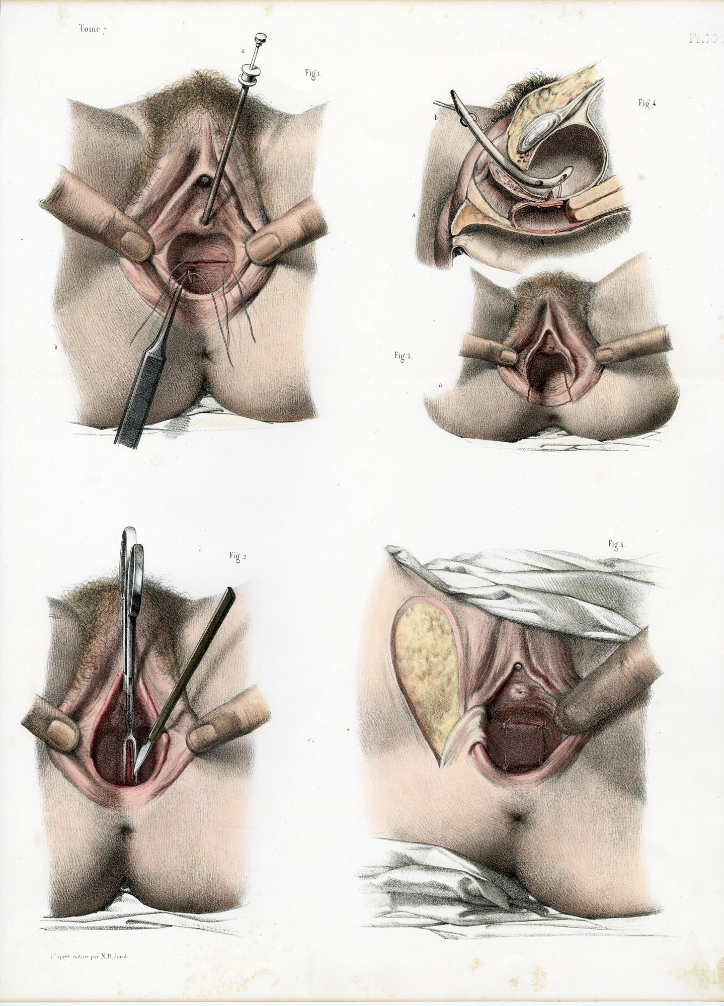 Pictura 14086 416x578 Catalogue-Bourgery-Human anatomy - Image 41