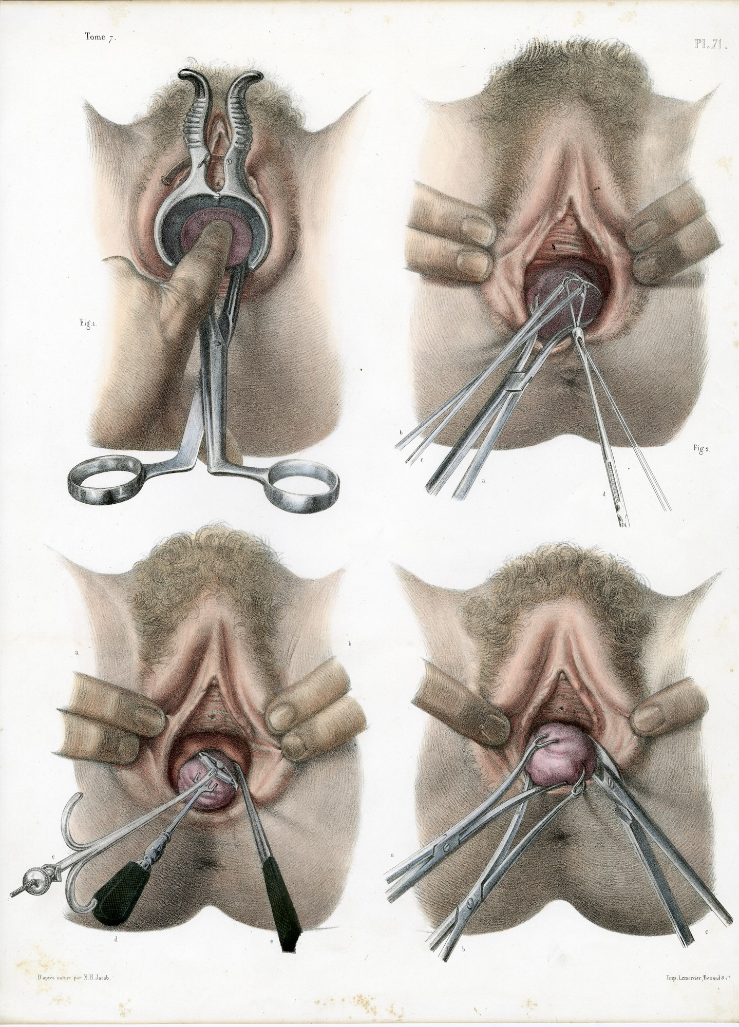 Pictura 14087 416x578 Catalogue-Bourgery-Human anatomy - Image 42