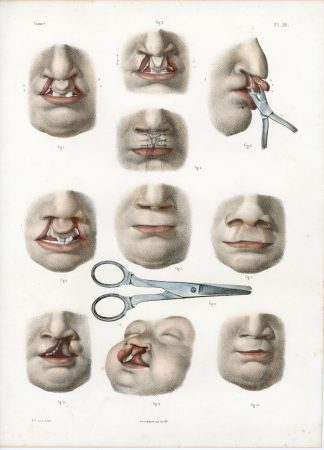 Antique Print-SURGERY-CLEFT LIP-HARE-PROCEDURE-INSTRUMENTS-Jacob-Bourgery-1831
