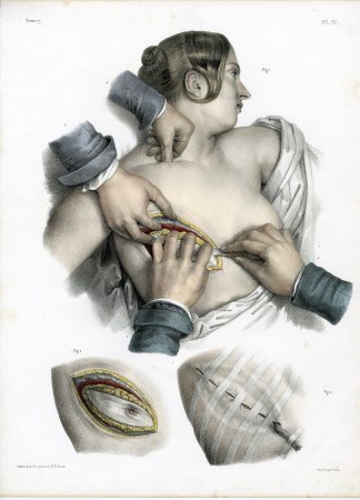 Antique Print-SURGERY-MASTECTOMY-BREAST-PROCEDURE-Jacob-Bourgery-1831