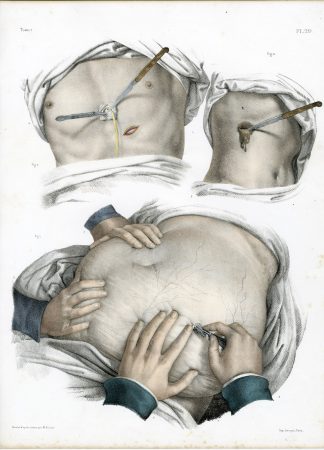 Antique Print-SURGERY-ABDOMEN-PUNCTURE-PROCEDURE-INSTRUMENTS-Jacob-Bourgery-1831