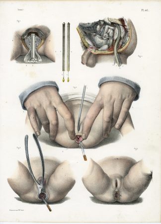 Antique Print-SURGERY-PELVIC REGION-PROCEDURE-INSTRUMENTS-Jacob-Bourgery-1831