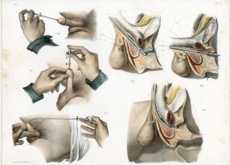 Antique Print-SURGERY-MALE URINARY TRACT-PENIS-INSTRUMENTS-Jacob-Bourgery-1831