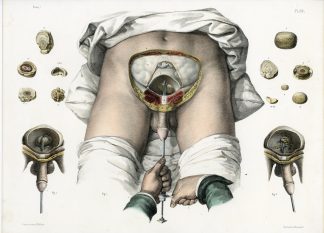 Antique Print-SURGERY-LITHOTOMY-KIDNEY STONES-INSTRUMENTS-Jacob-Bourgery-1831