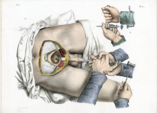 Antique Print-SURGERY-LITHOTRIPSY-BLADDER STONES-INSTRUMENTS-Jacob-Bourgery-1831