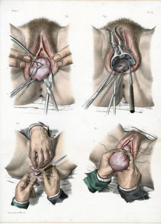 Antique Print-SURGERY-UTERUS-TUMOR-SPECULUM-PELVIC ORGANS-Jacob-Bourgery-1831