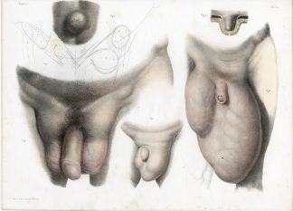 Antique Print-SURGERY-SCROTUM-PENIS-HERNIA-SWELLING-PROCEDUR-Jacob-Bourgery-1831