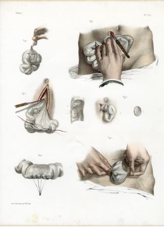 Antique Print-SURGERY-INTESTINES-SUTURING-RESECTION-PROCEDUR-Jacob-Bourgery-1831