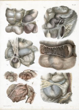 Antique Print-SURGERY-INTESTINES-VOLVULUS-BOWEL-PROCEDURE-Jacob-Bourgery-1831