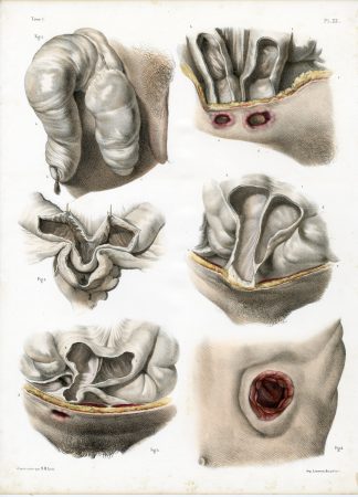 Antique Print-SURGERY-ARTIFICIAL ANUS-PROLAPSE-PROCEDURE-Jacob-Bourgery-1831