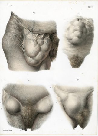 Antique Print-SURGERY-FEMALE HERNIA-BANDAGE-PROCEDURE-Jacob-Bourgery-1831