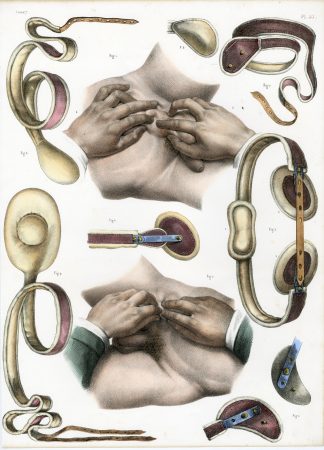 Antique Print-SURGERY-MALE HERNIA-BELT-STRAP-PROCEDURE-Jacob-Bourgery-1831