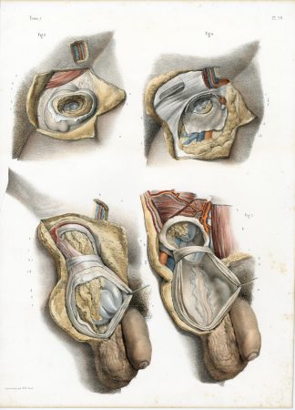 2-Antique Prints-SURGERY-MALE HERNIA-INGUINAL REGION-PROCEDURE-Jacob-Bourgery-1831