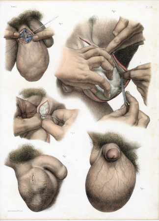 Antique Print-SURGERY-TESTICLES-SCROTUM-SUTURING-PROCEDURE-Jacob-Bourgery-1831