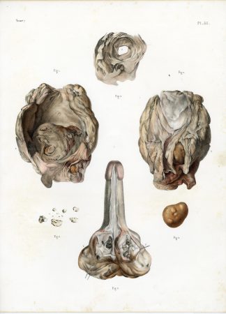 Antique Print-SURGERY-BLADDER-PROSTATE-CALCULI-PROCEDURE-Jacob-Bourgery-1831