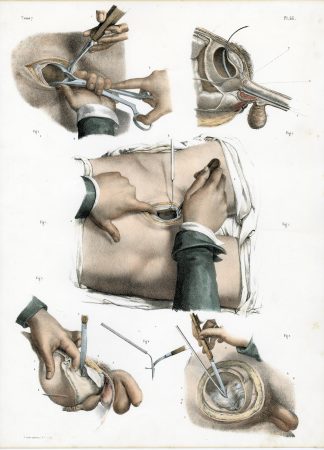 2-Antique Prints-SURGERY-BLADDER STONES-CALCULI-PROCEDURE-Jacob-Bourgery-1831