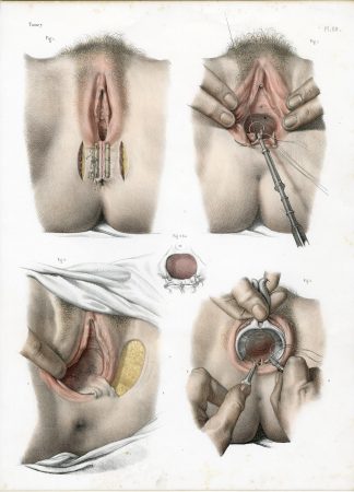 3-Antique Prints-SURGERY-FISTULA-RECTUM-VAGINA-UTERUS-Jacob-Bourgery-1831