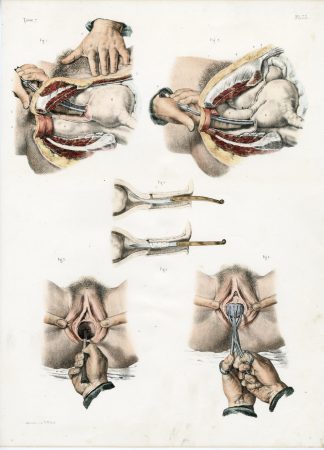 Antique Print-SURGERY-GYNECOLOGICAL EXAMINATION-VAGINA-Jacob-Bourgery-1831