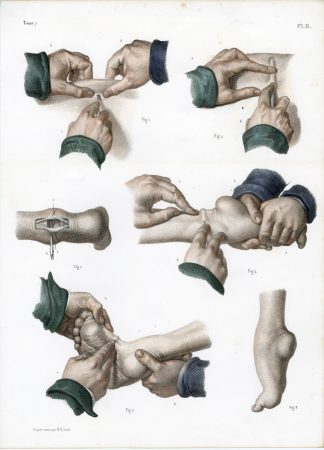 Antique Print-SURGERY-TENOTOMY-CLUBFOOT-ACHILLES TENDON-Jacob-Bourgery-1831