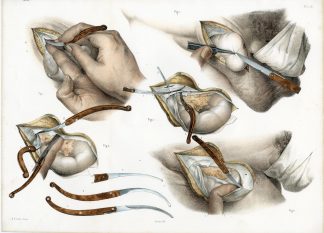 2-Antique Prints-SURGERY-REDUCIBLE HERNIA-PROCEDURE-Jacob-Bourgery-1831