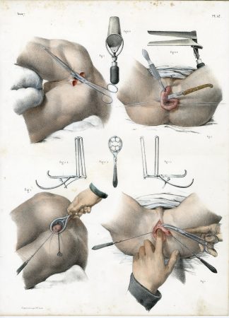 Antique Print-SURGERY-ARTIFICIAL ANUS-LEFT LUMBAR-INSTRUMENT-Jacob-Bourgery-1831